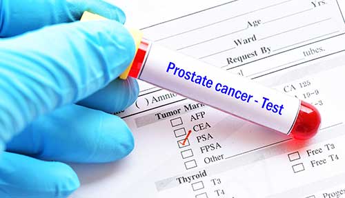PSA test prostate cancer screening photo