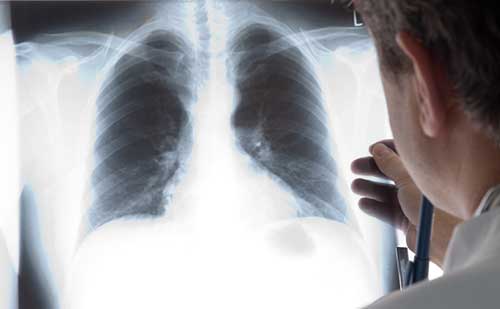 radiologist reviewing lung x-ray for cancer diagnosis